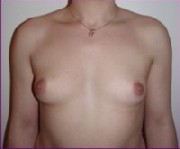 Before large implants 650cc